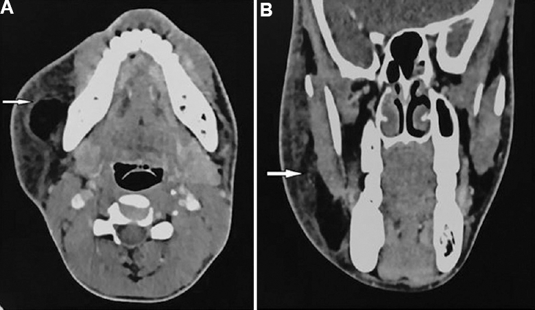 Axial (A) and coronal (B) contrast-enhanced computed tomographic scan images showing subcutaneous oedema and fat reticulations (white arrows) in the right parotid region with an irregular outline of the right parotid gland.